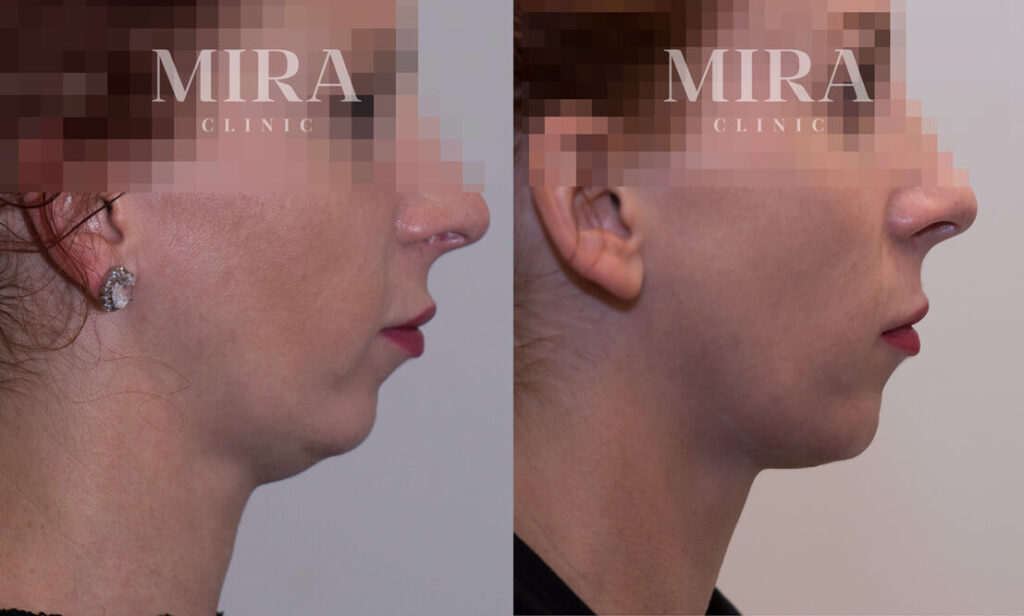 Progress Report On Double Chin Dissolving Injections - MIRA Clinic