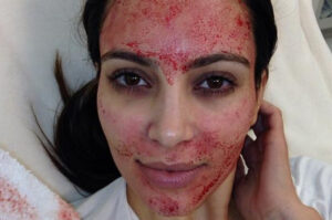 Prp feature img - mira clinic - 3