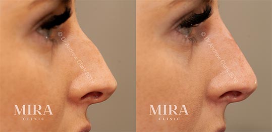 Mira clinic liquid nose job rhinoplasty before and after1 - mira clinic - 3