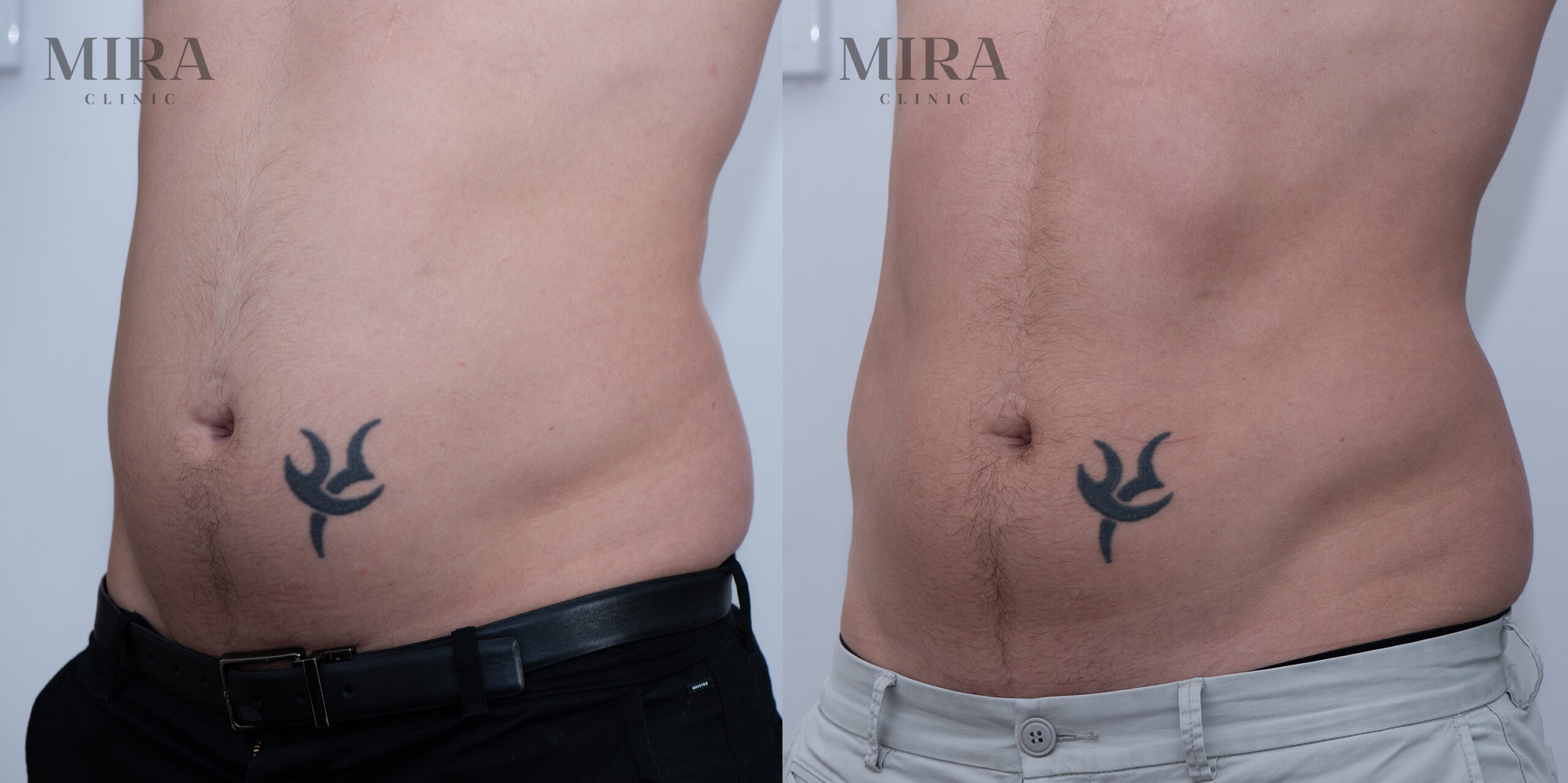 Unnamed 1 scaled - mira clinic - 5