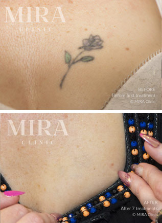 Mira clinic tattoo removal before after 1 - mira clinic - 5